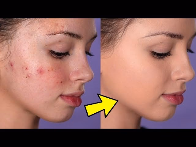 Can pimples be covered with makeup?