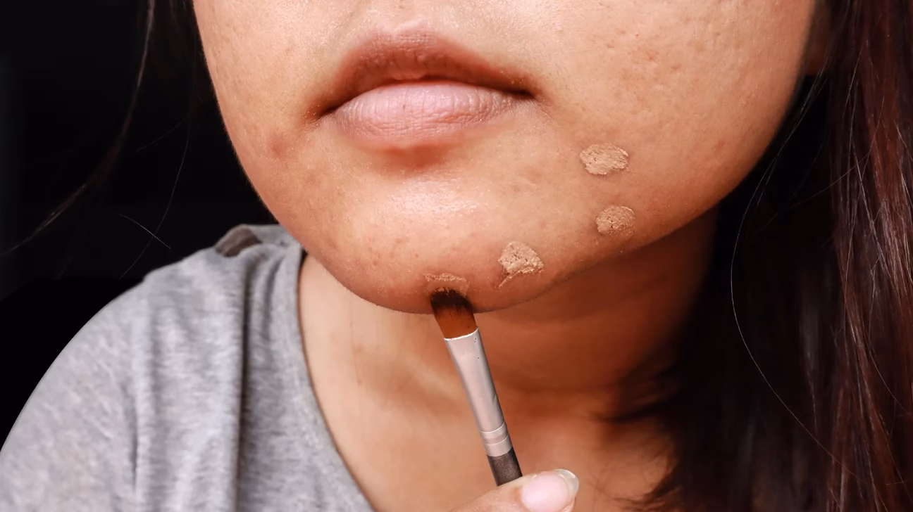 What is the best cover up makeup for acne?