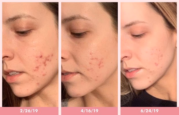 How to hide acne under makeup?