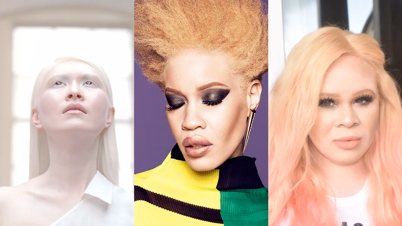 Who is the famous albino model in history?