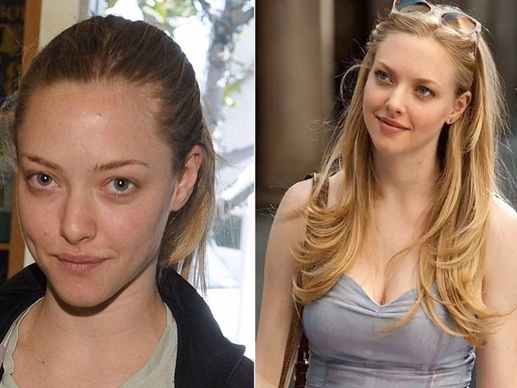 What condition does Amanda Seyfried have?