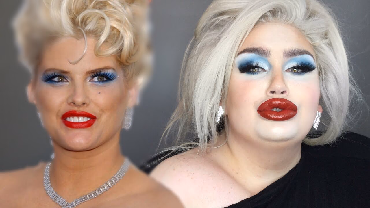 What autoimmune disease did Anna Nicole Smith have?