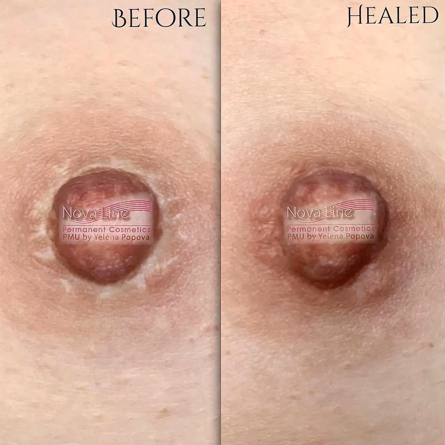 How long does areola tattooing last?