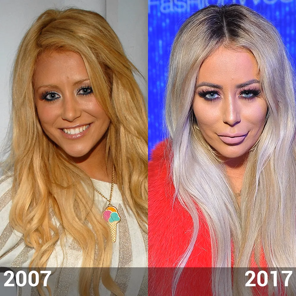 What surgery has Aubrey O'Day had?
