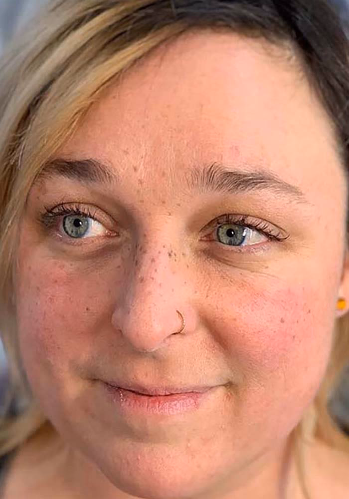 How long do cosmetic freckles last?