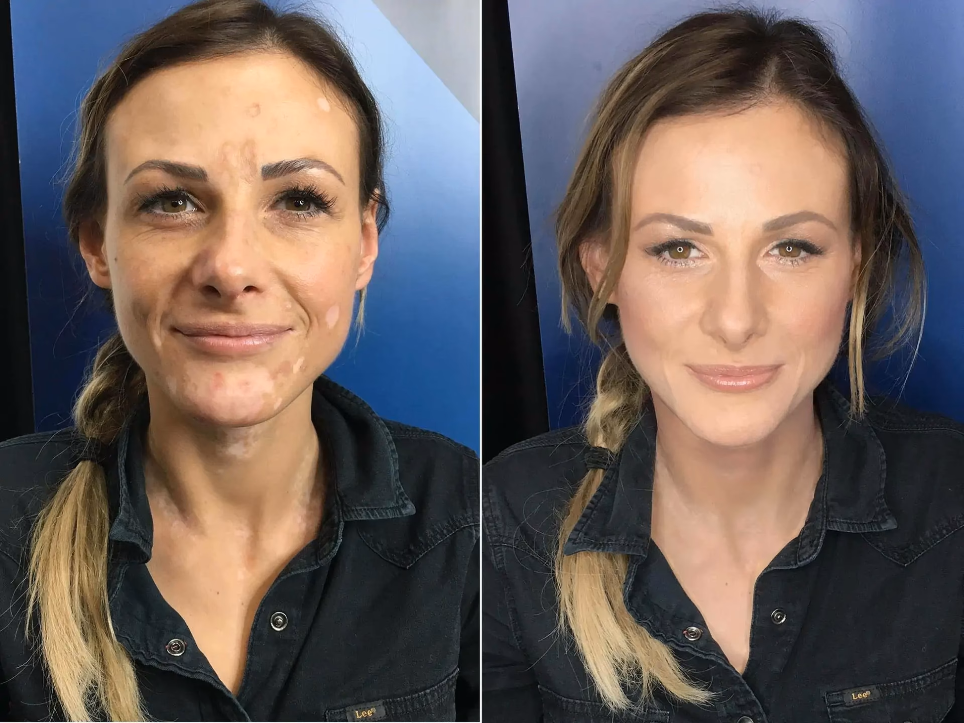 Does concealer cover vitiligo?