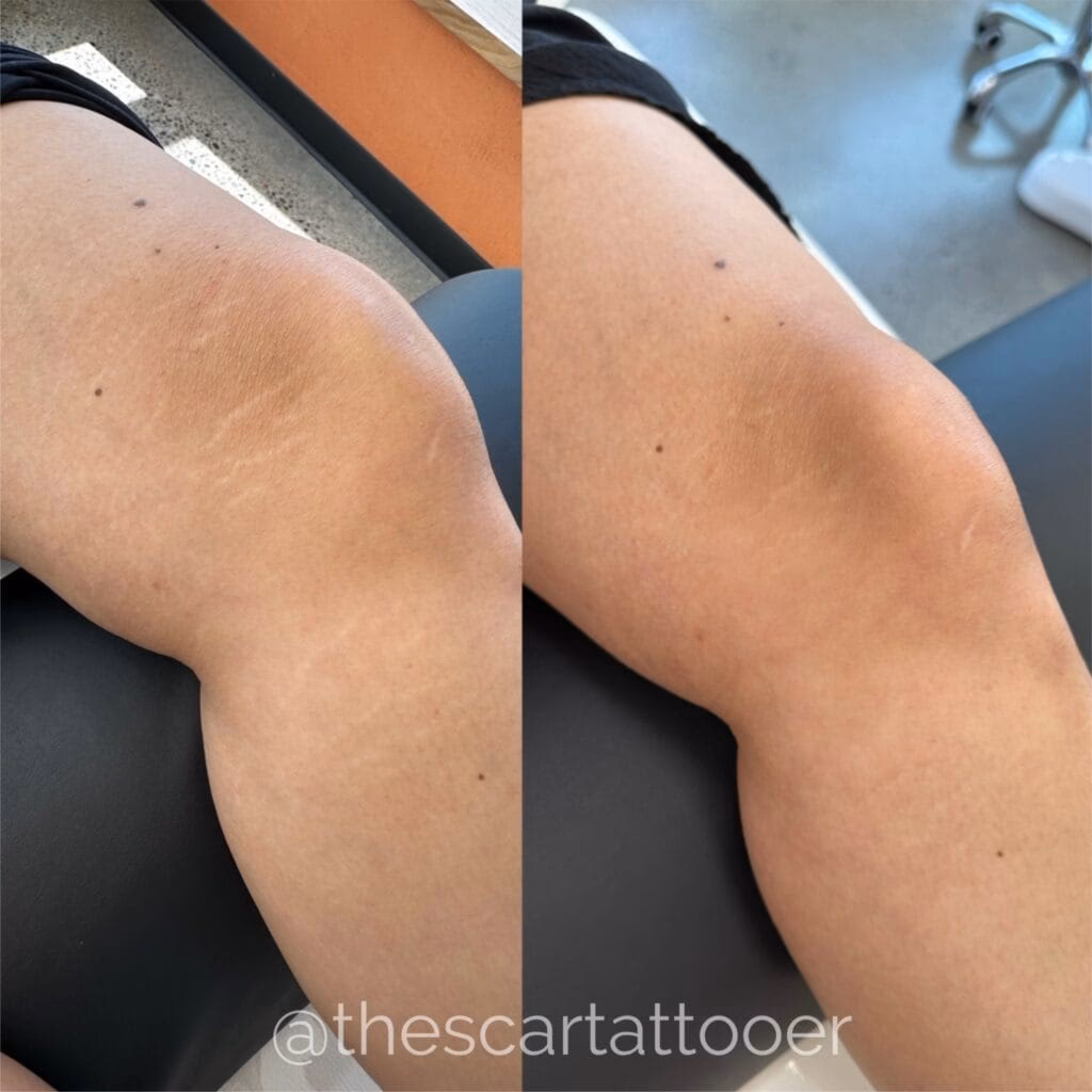 Can you camouflage stretch marks?