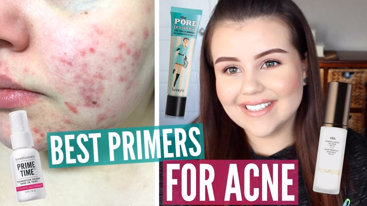 Which primer is the best for acne-prone skin?