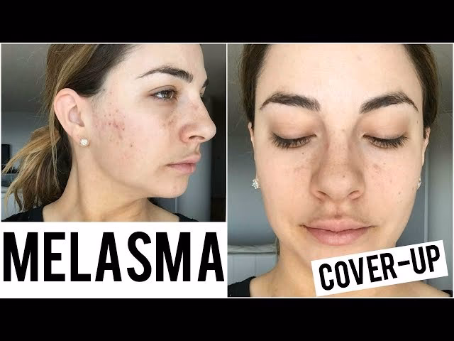How to hide melasma without makeup?