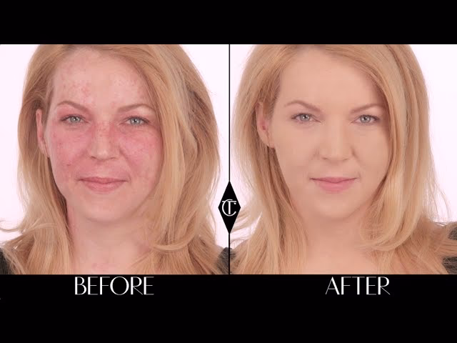 Can Dermablend cover birthmarks?