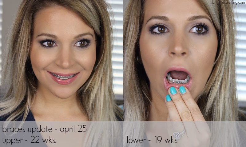 Is it safe to make out with someone with braces?