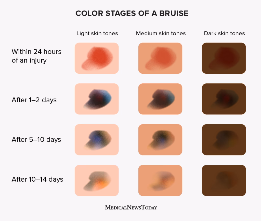 What is the evolution of bruise colors?