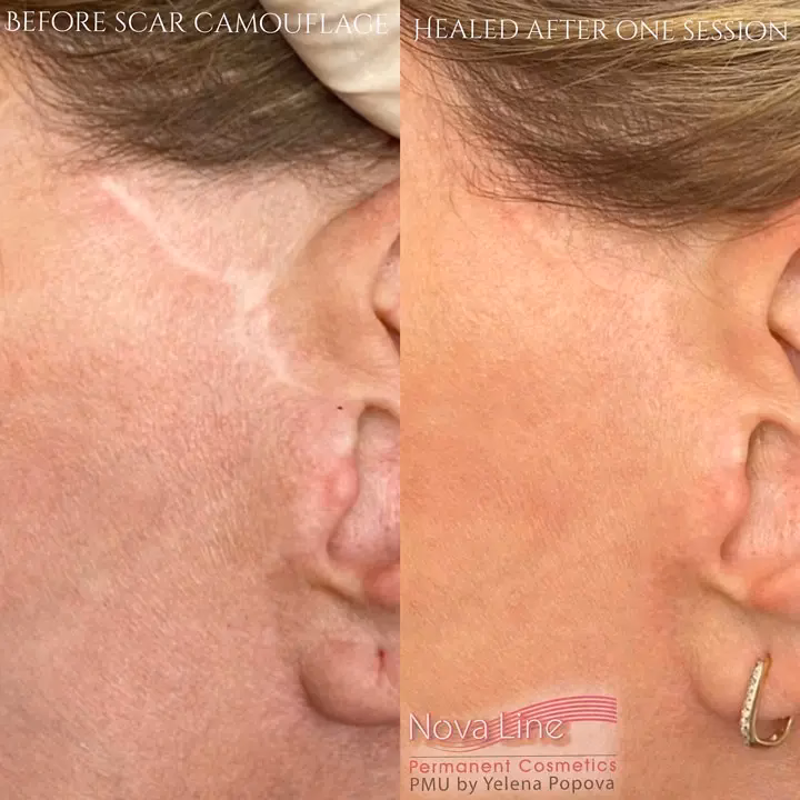 Can you camouflage hyperpigmentation?