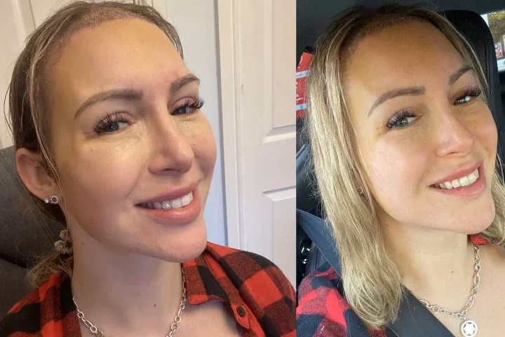 When can I wear makeup after hair transplant?