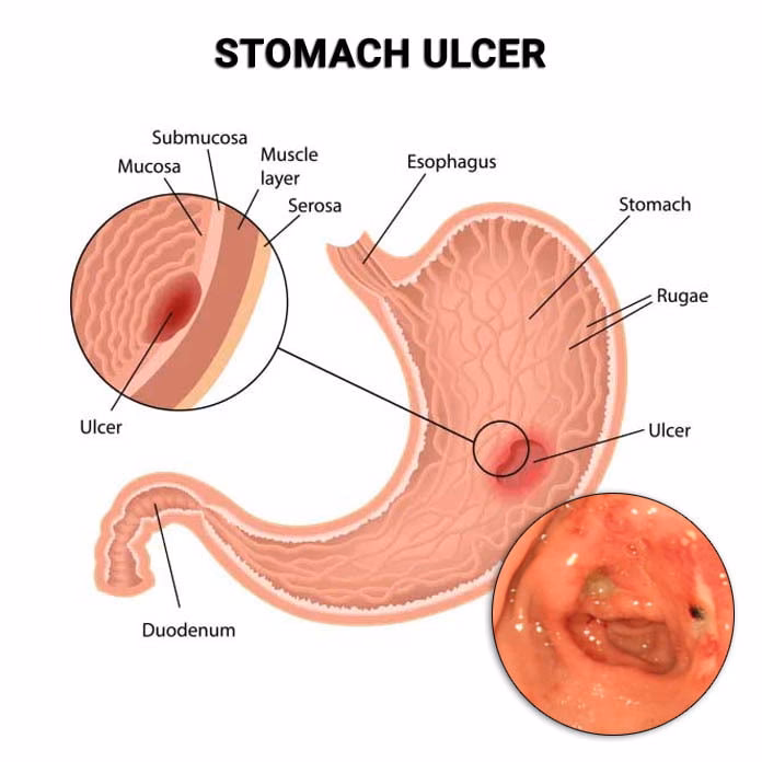 What are the worst symptoms of an ulcer?