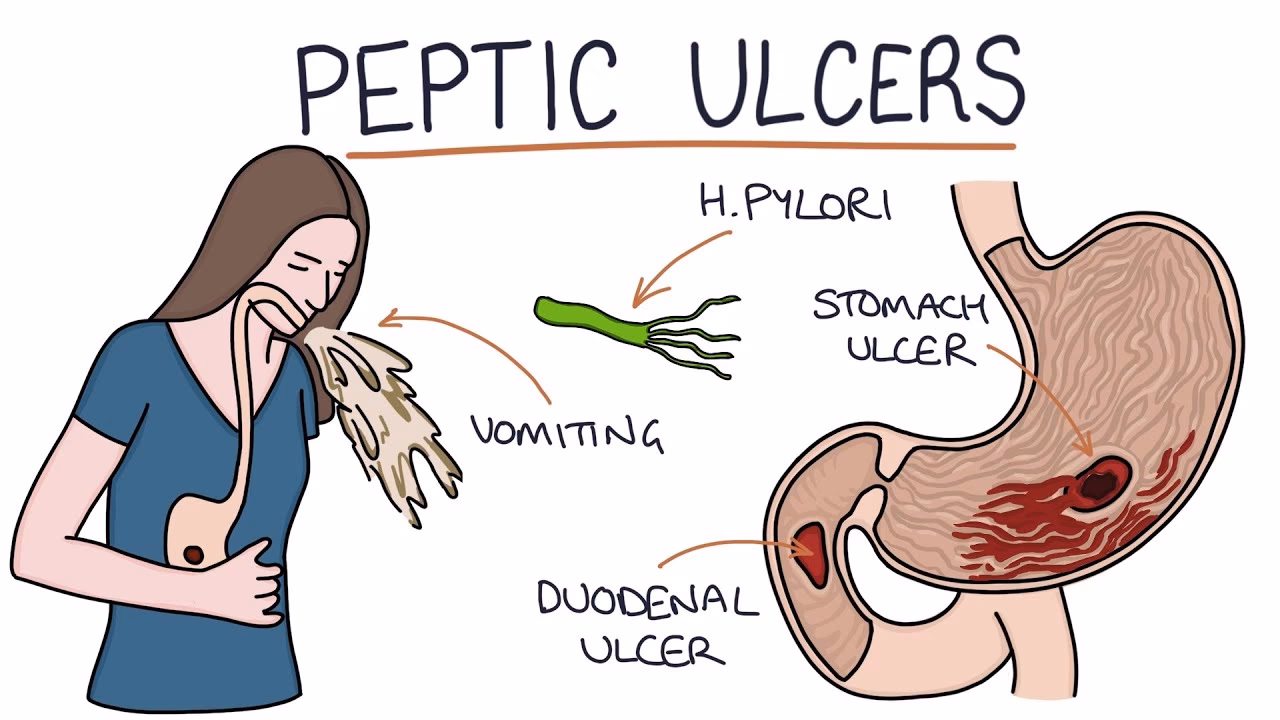 What are the worst symptoms of an ulcer?