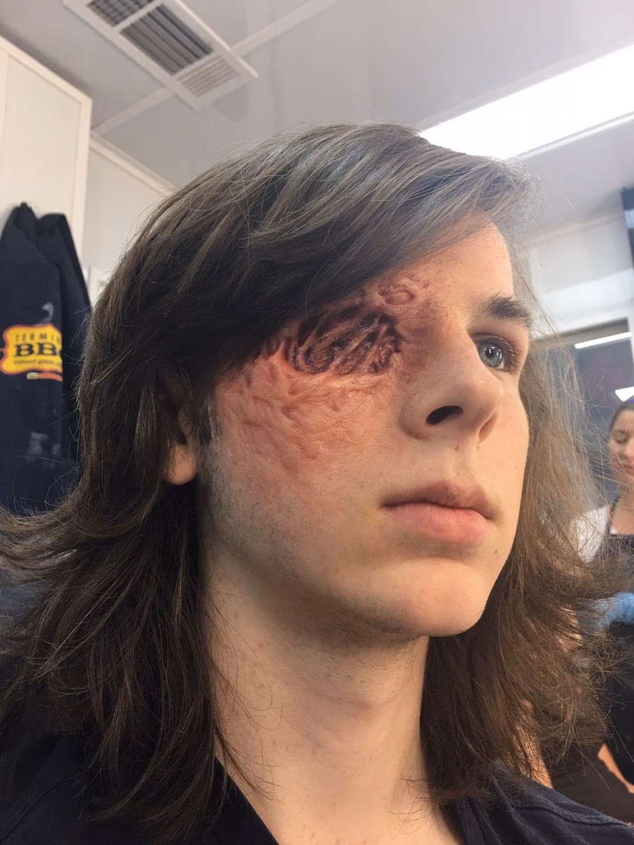 Why does Carl Grimes' eye look like that?