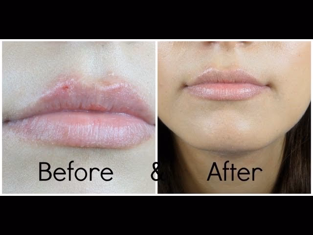 Can I cover herpes with makeup?