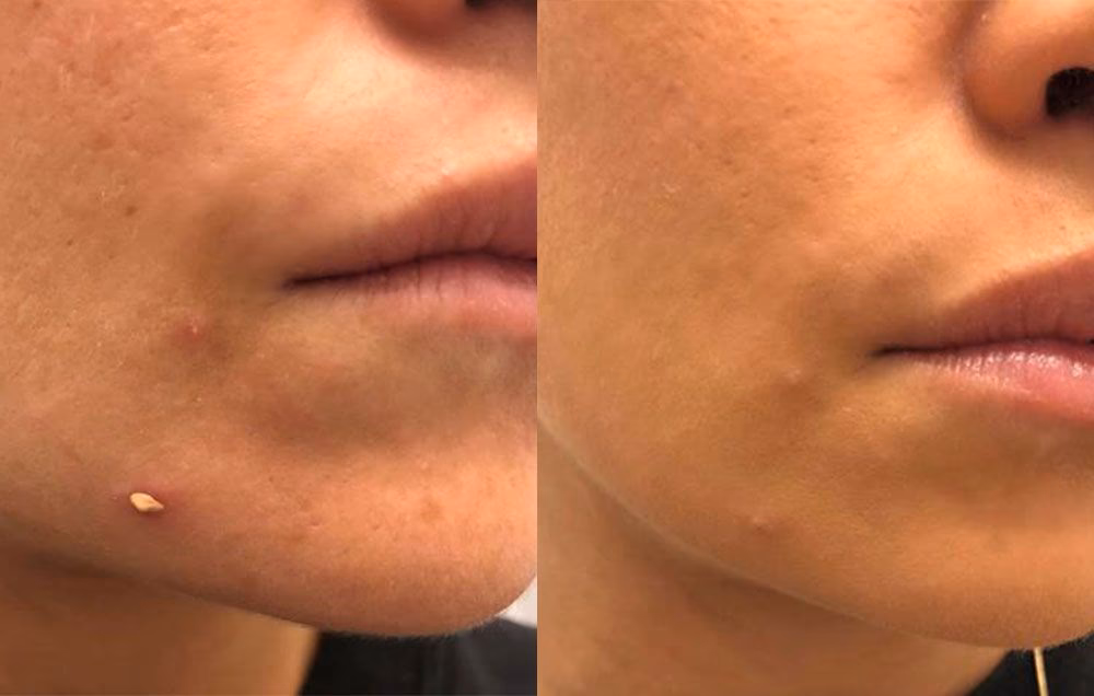 How to cover up a noticeable pimple?