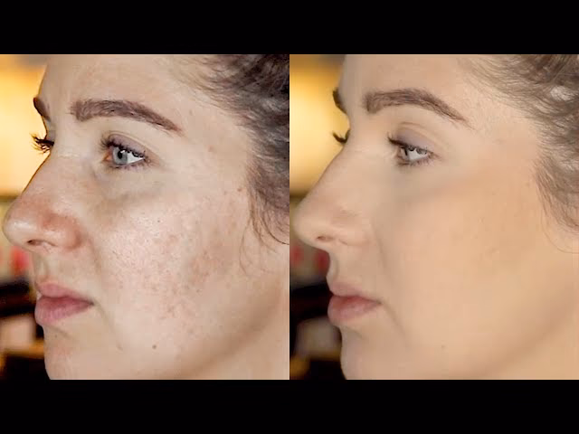 Is there a foundation that covers acne scars?
