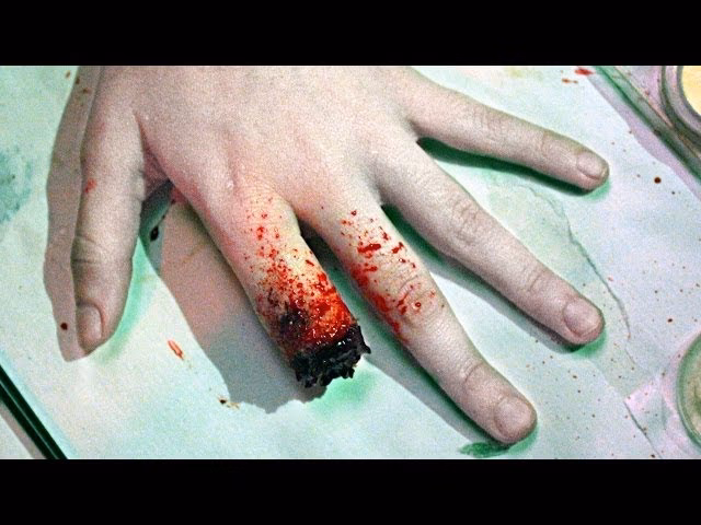 ¿Cuánto tiempo tarda en cicatrizar un dedo amputado?