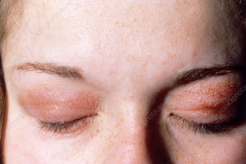 How do you treat eye makeup allergies?