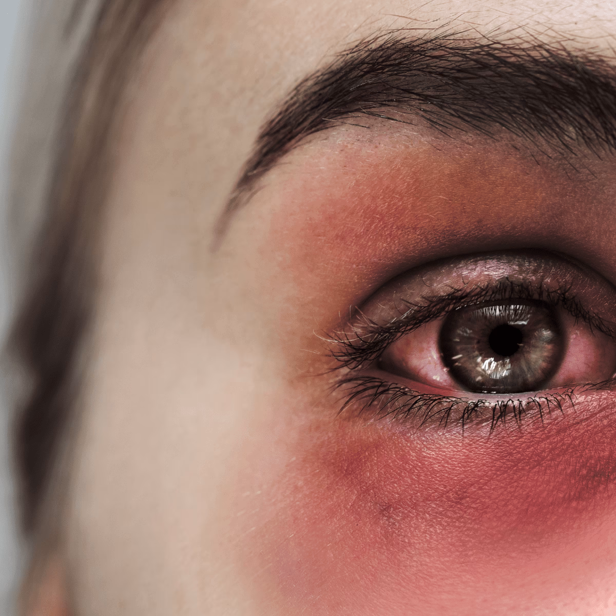 How can I hide my eye bruises?