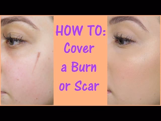 Can scars be hidden with makeup?