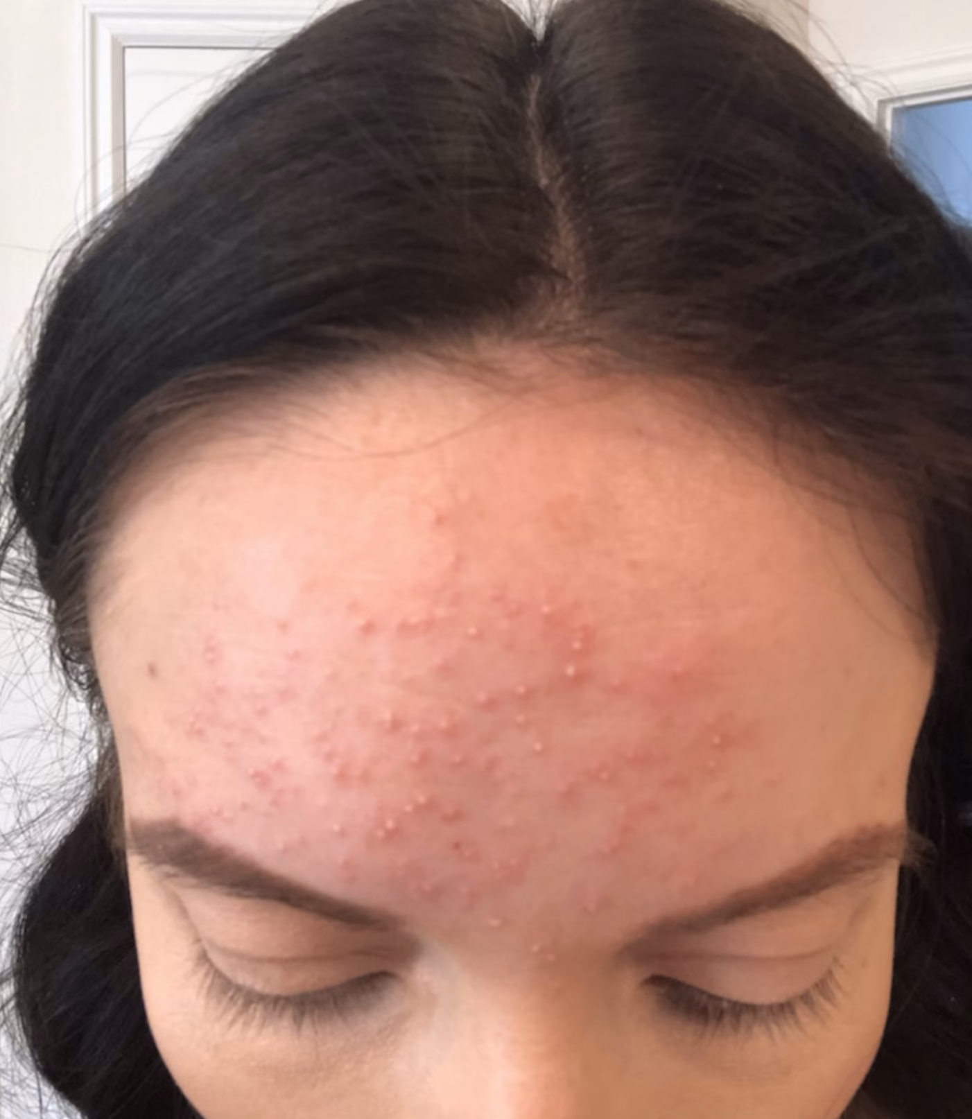 How can I make my allergic reaction go away faster?