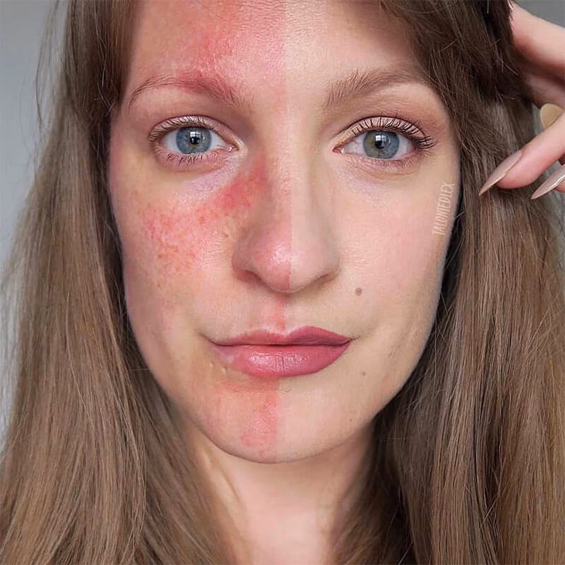 Is it bad to put makeup over rosacea?