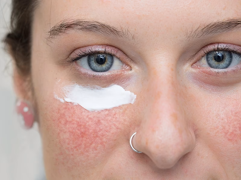 ¿Qué maquillaje cubrirá la rosácea?