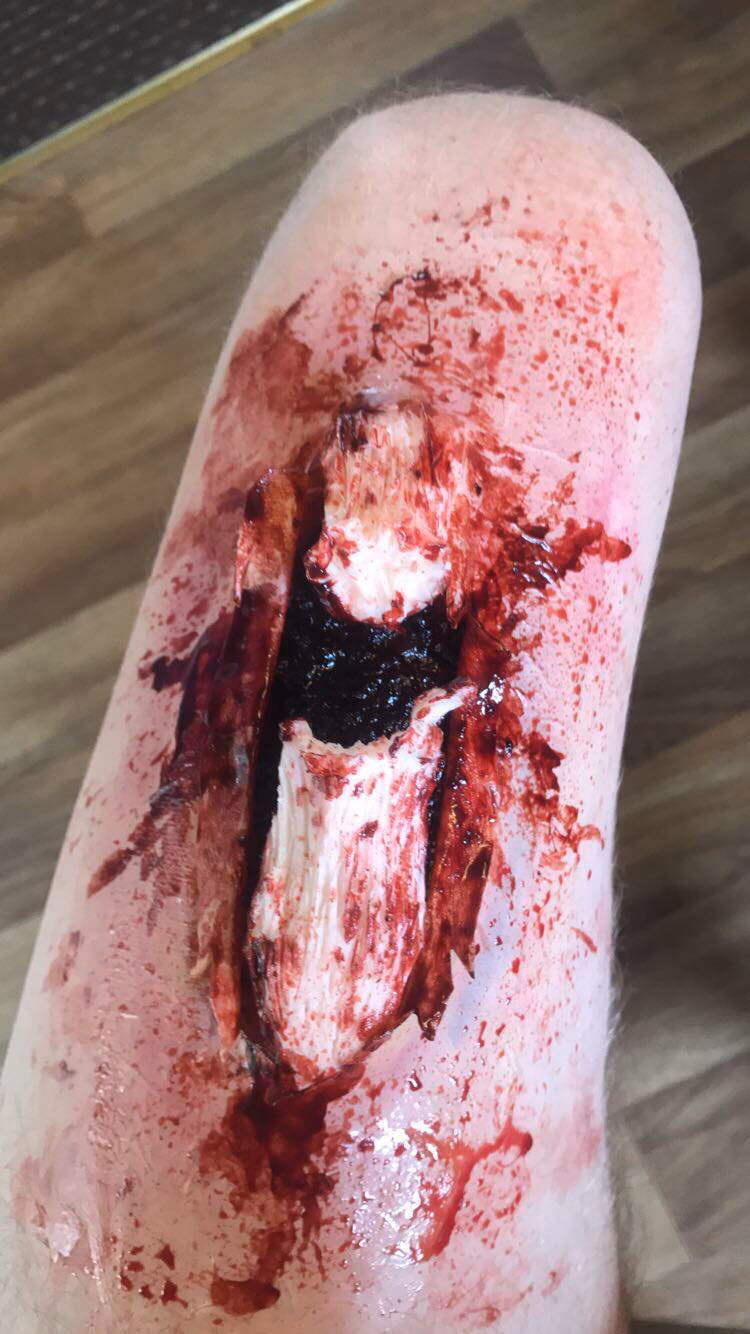 Can a leg injury make you feel sick?