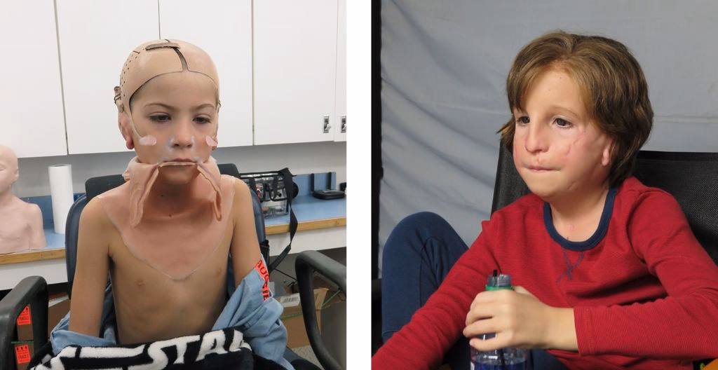 How did Auggie's face get messed up?