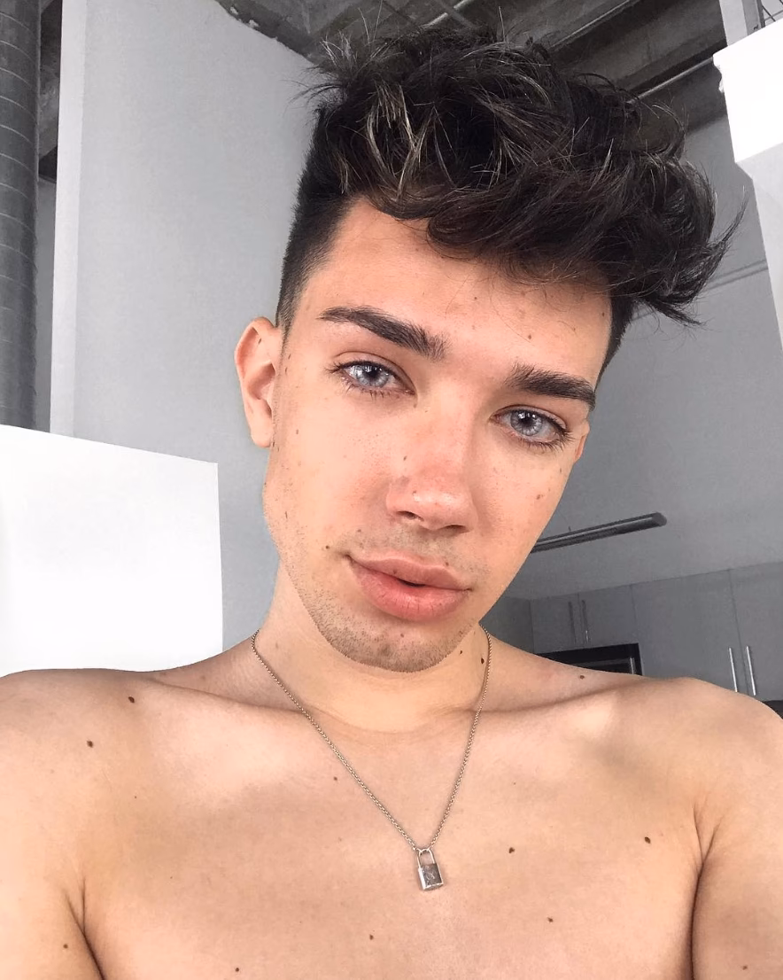 Does James Charles have lip fillers?