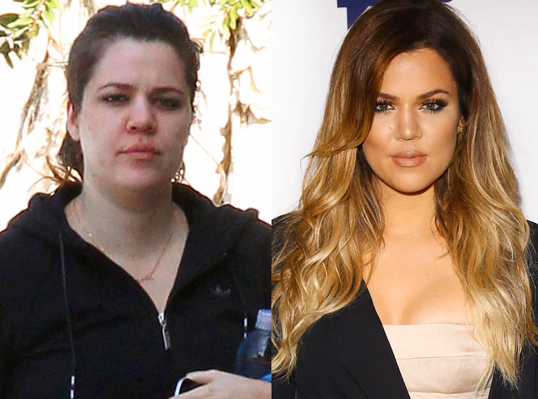 What did Khloe Kardashian have removed on her face?