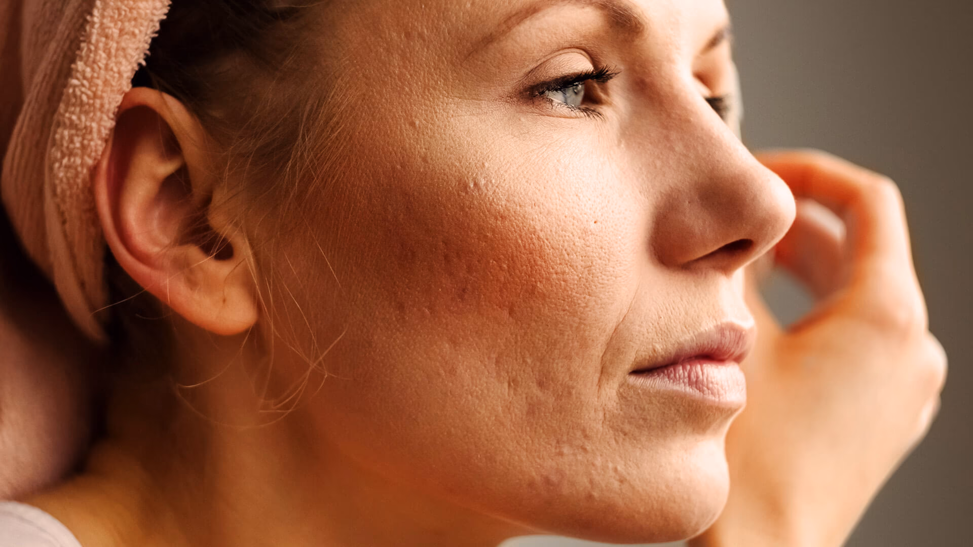 Kann man Make-up tragen, wenn man Rosazea hat?