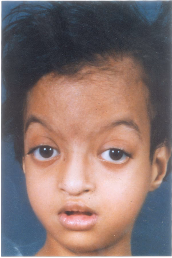 What is the Kabuki syndrome?