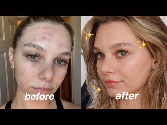 How to do your makeup when you have acne?
