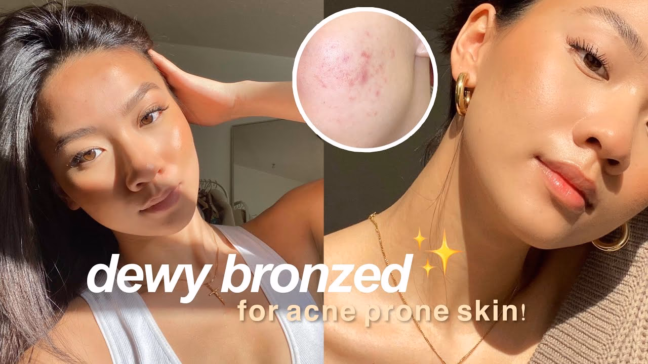 What makeup should I wear if I have acne?