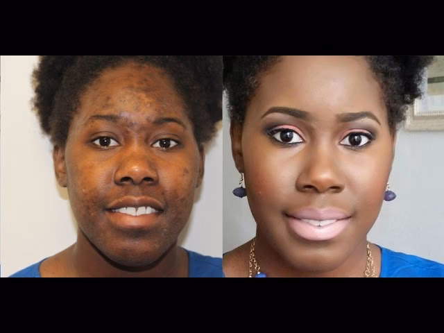 What makeup is best for hyperpigmentation?