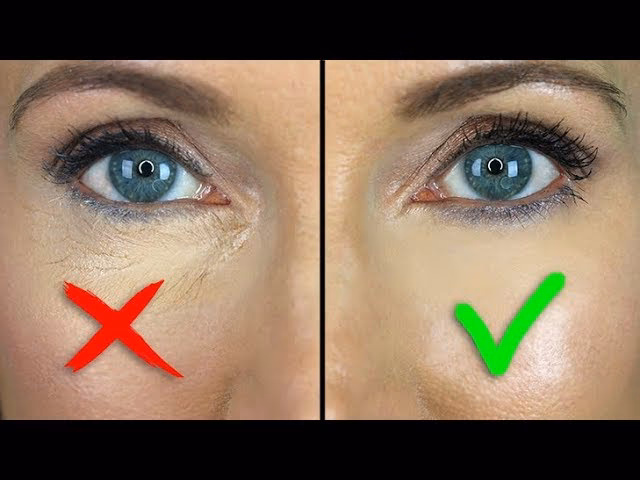 Can you fill under eye wrinkles?