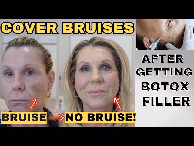 What makeup is best to cover a bruise?