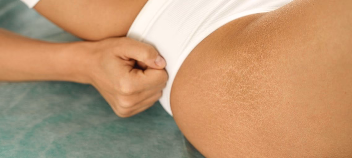 Is there anything to cover up stretch marks?