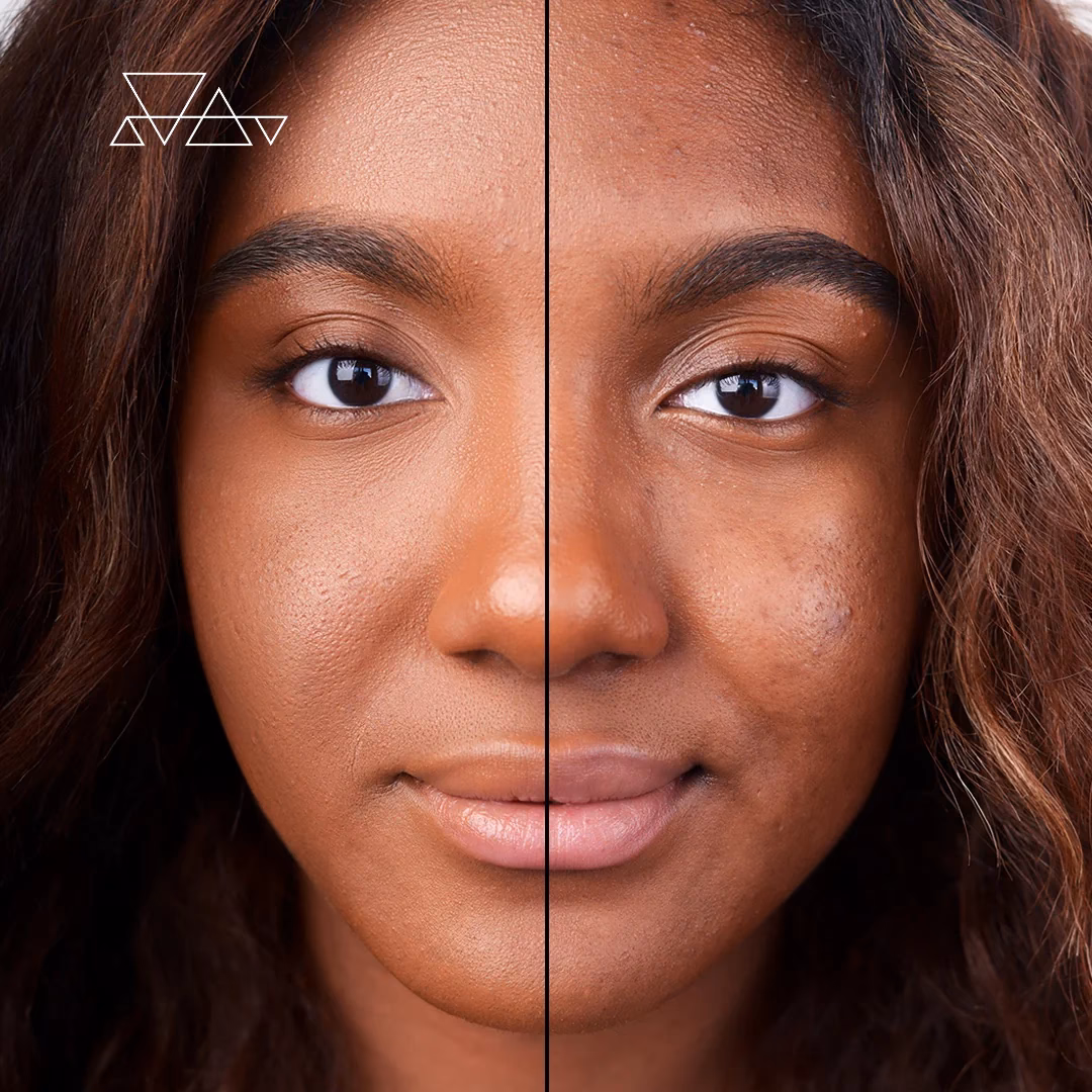 Is mineral good for acne prone skin?