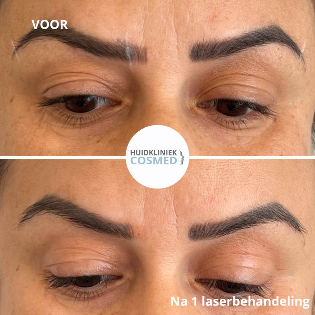 Waarom verdwijnt mijn permanente make-up?