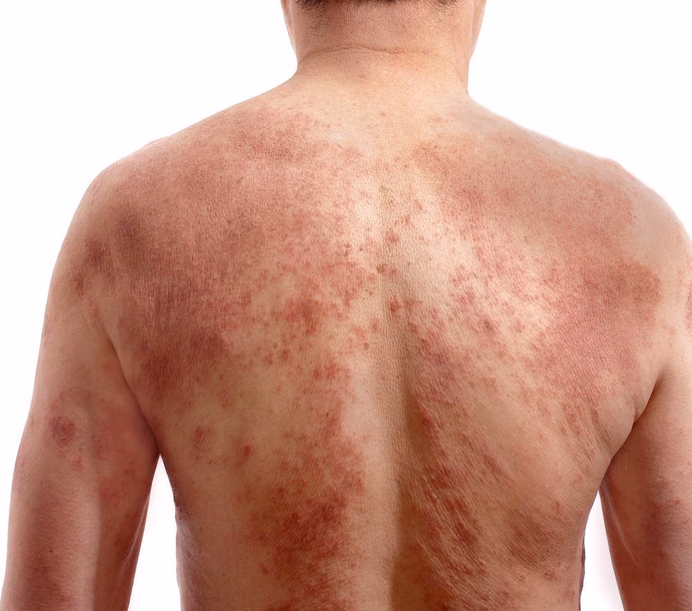 What is the main ingredient that makes eczema flare up?