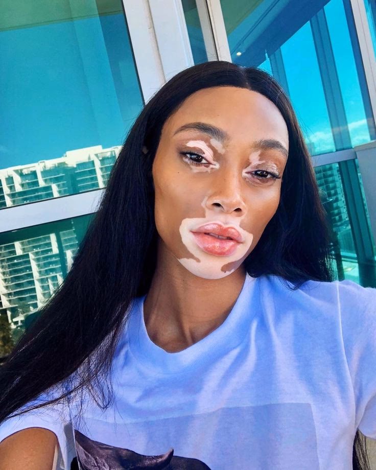 When did Winnie get vitiligo?