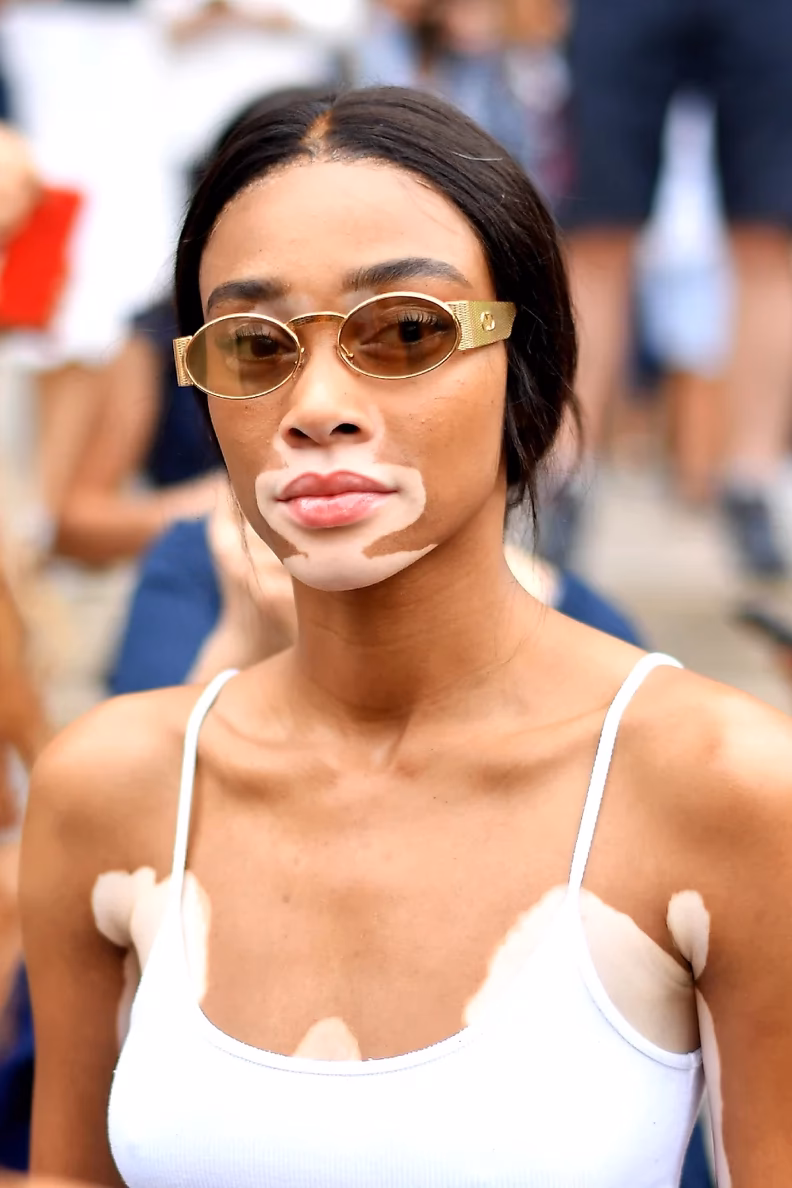 When did Winnie get vitiligo?